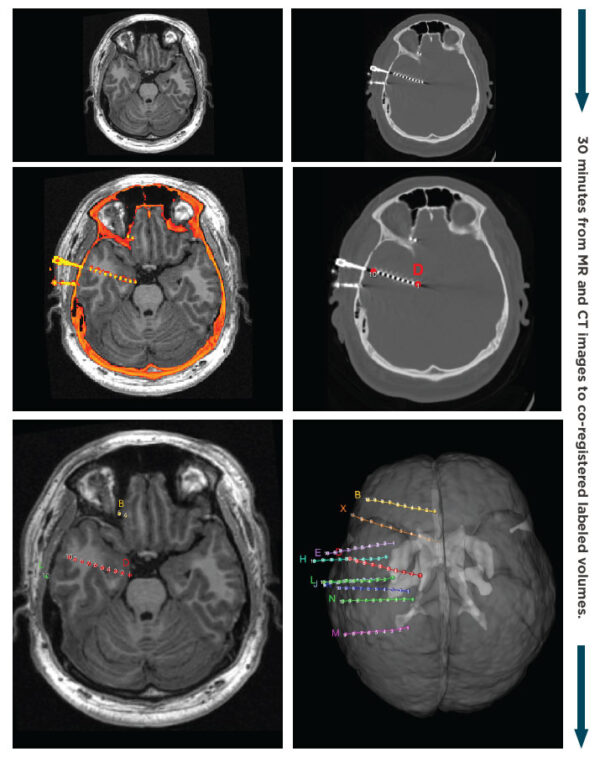 Ieeg Imaging And Analysis Persyst